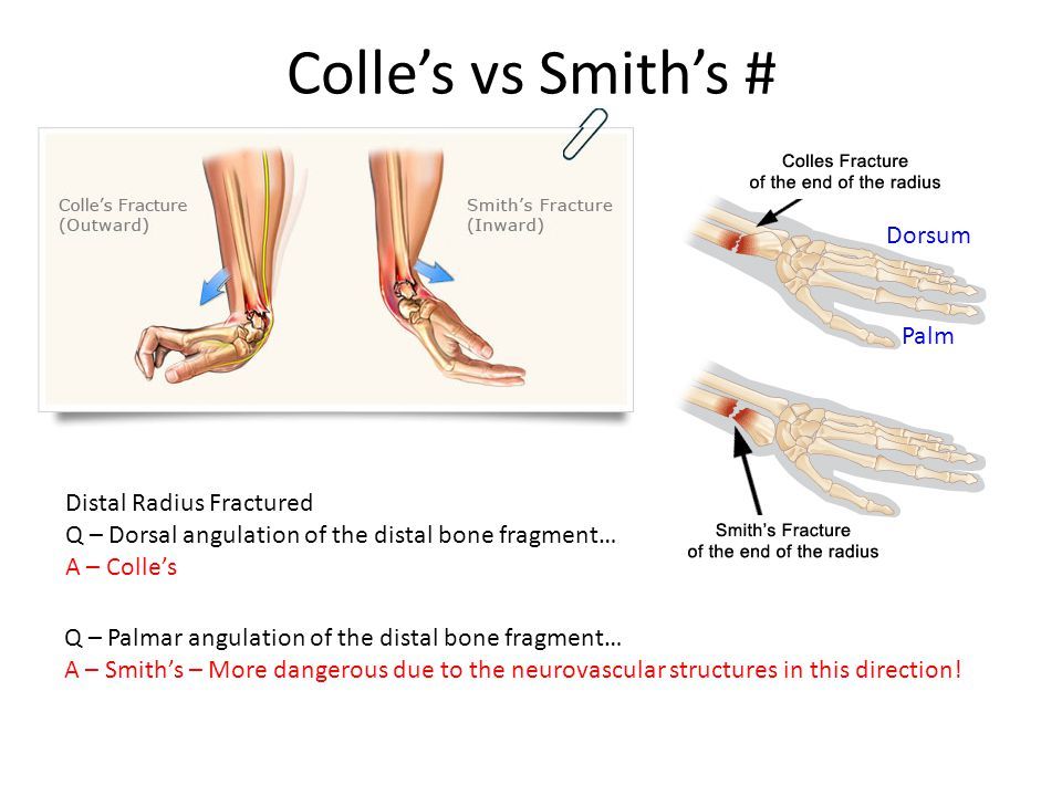 Smith Fracture Smith Fracture