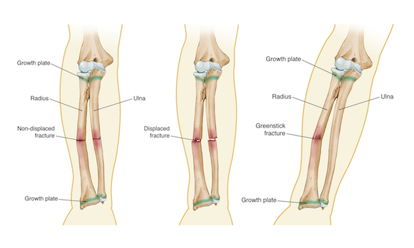 Forearm Fracture Near Elbow Joints Forearm Fracture Near Elbow Joints