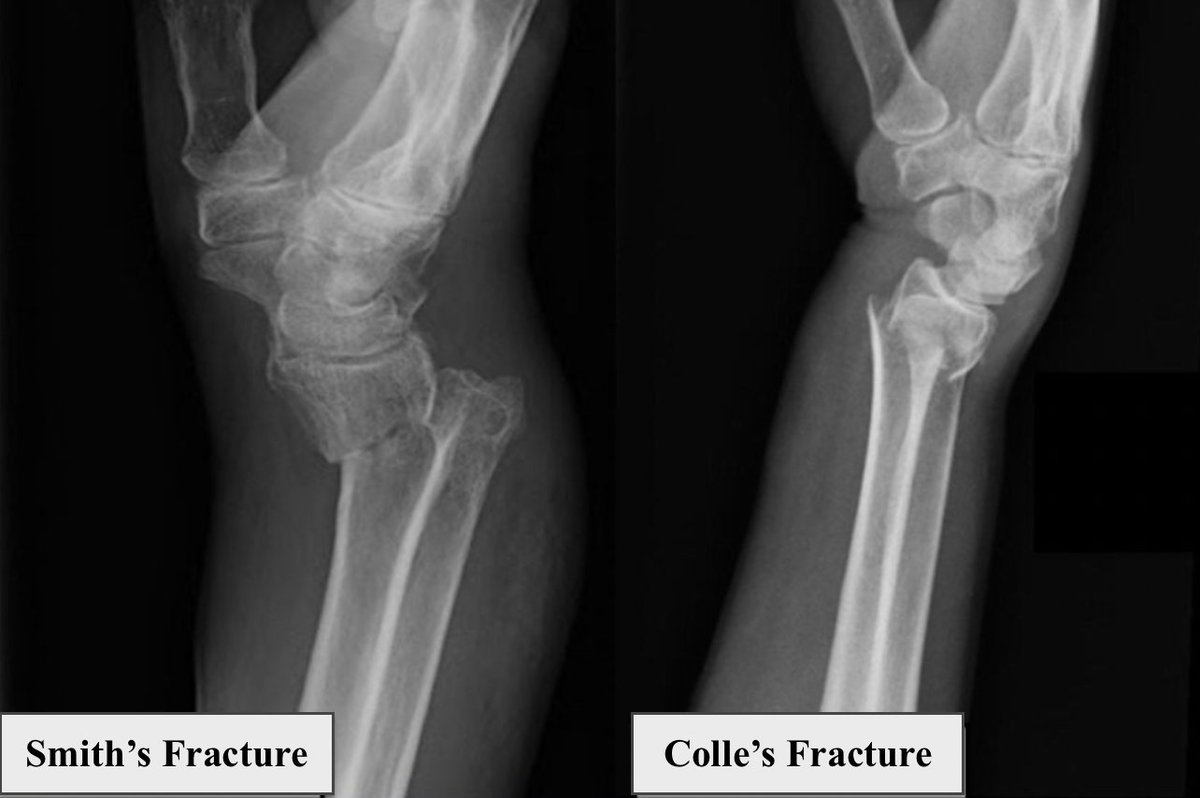 Smith Fracture Smith Fracture