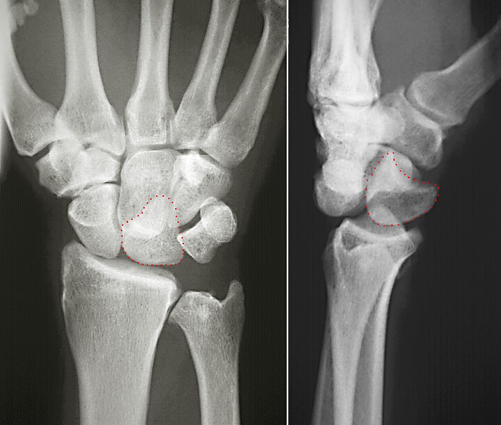 Carpal Bones Carpal Bones