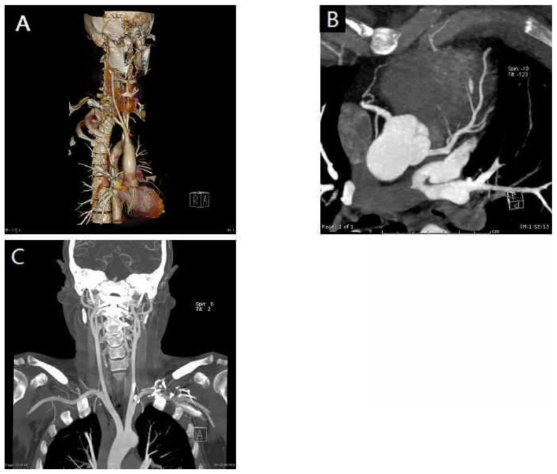 Contrast CT