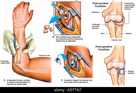 Forearm Fracture Near Elbow Joints Forearm Fracture Near Elbow Joints