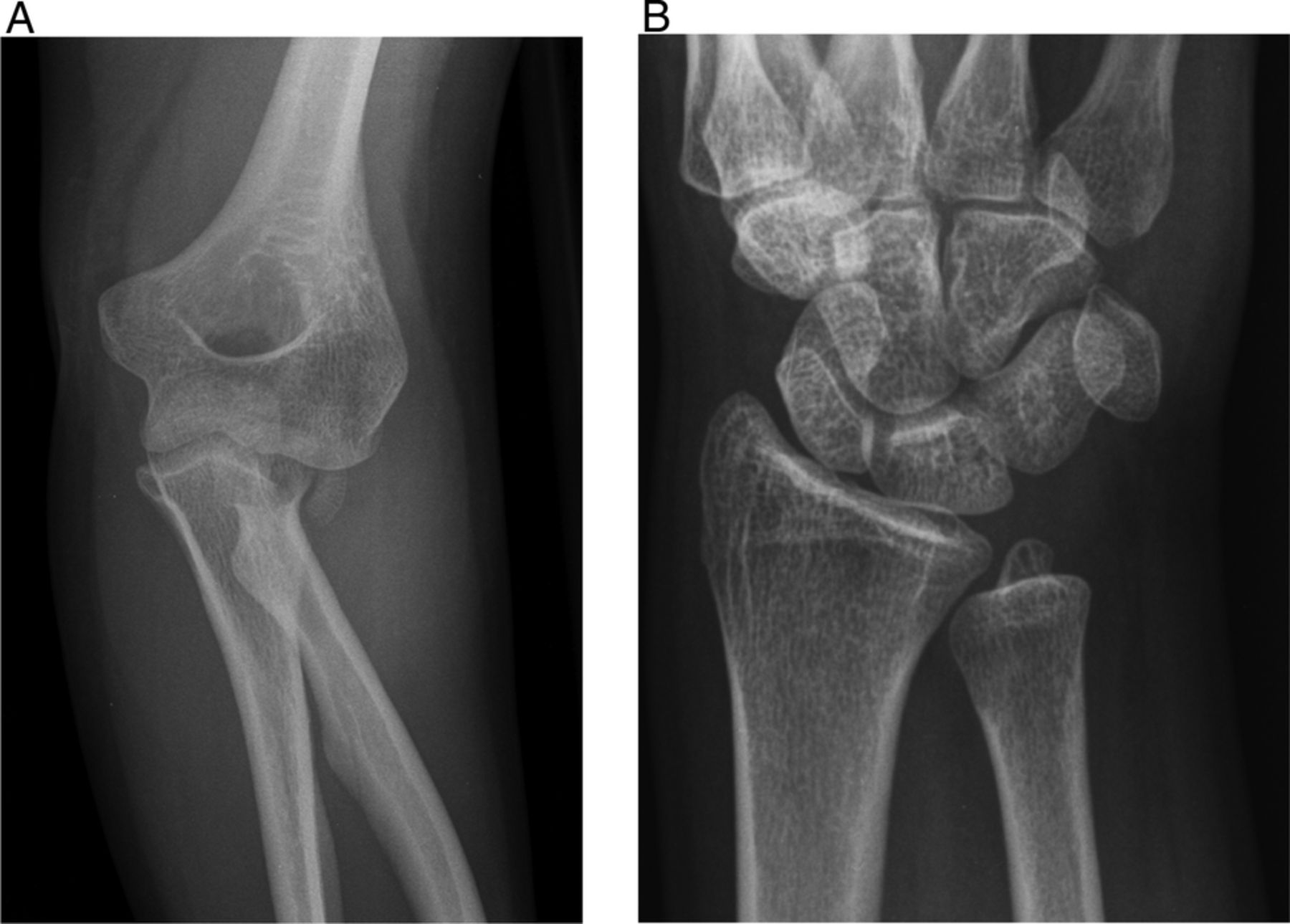 Essex-Lopresti Fracture Dislocation