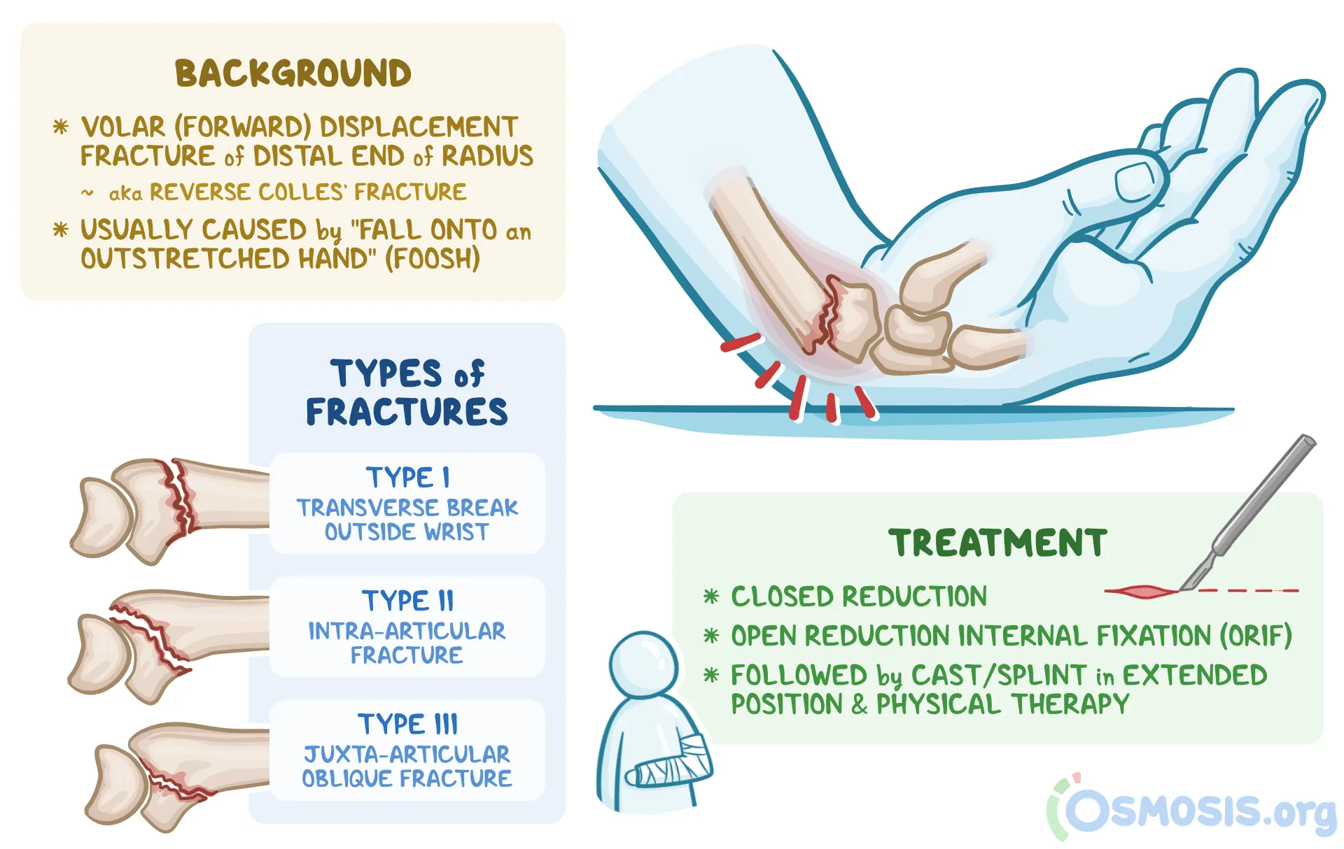 Smith Fracture Smith Fracture