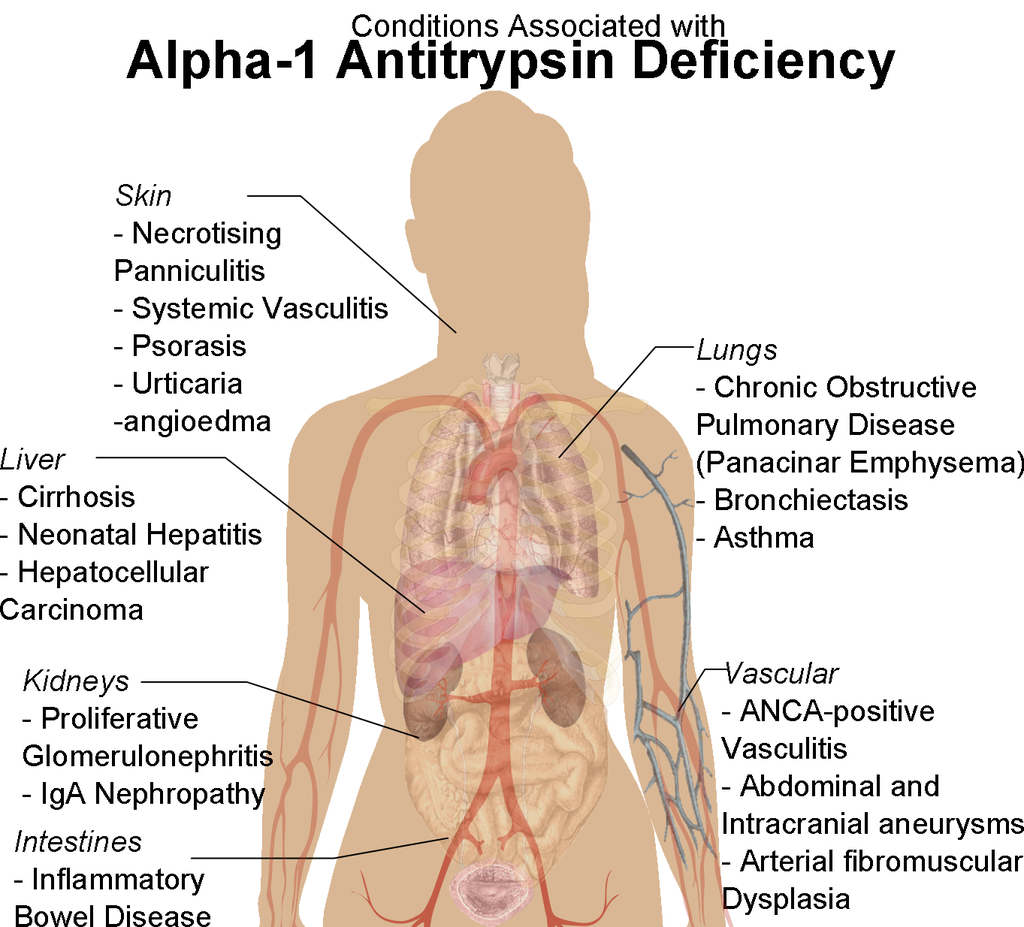 Alpha-1 Antitrypsin Deficiency (A1AD) Alpha-1 Antitrypsin Deficiency (A1AD)