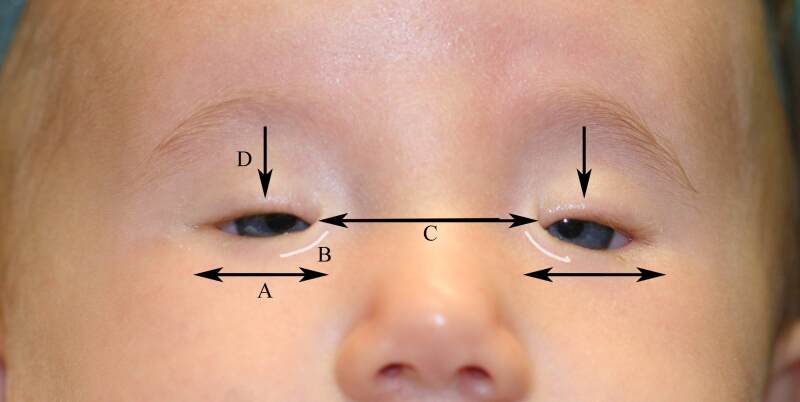 Blepharophimosis Blepharophimosis