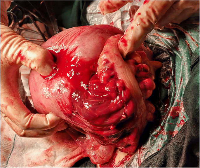 Ruptured Uterus - Causes, Symptoms, Diagnosis, Treatment Ruptured Uterus - Causes, Symptoms, Diagnosis, Treatment