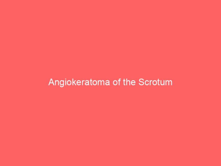 Angiokeratoma of the Scrotum
