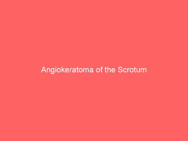 Angiokeratoma of the Scrotum