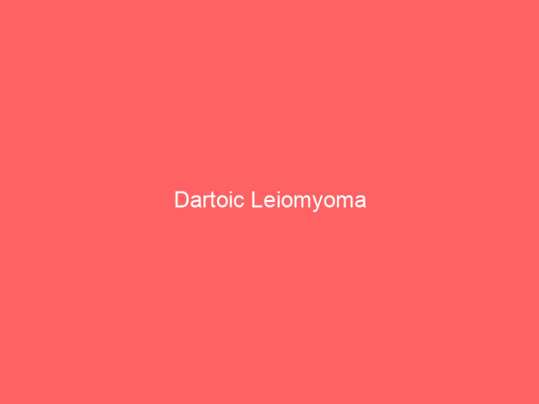 Dartoic Leiomyoma