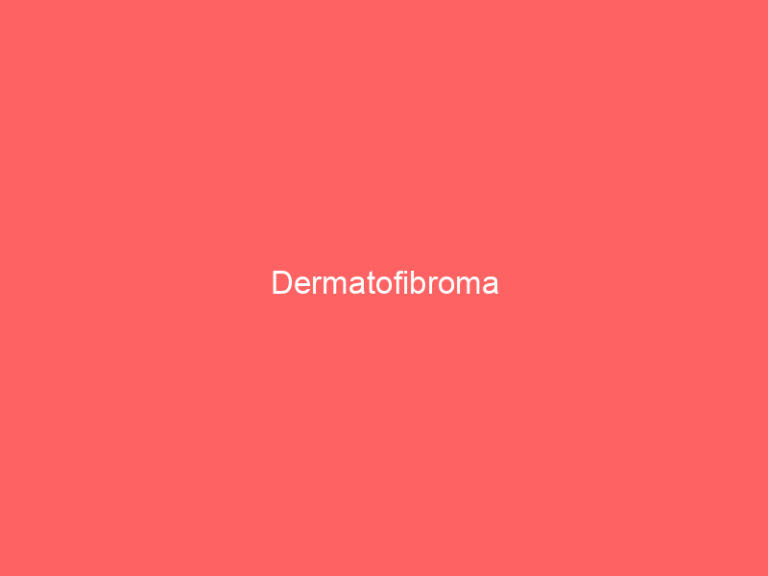 Dermatofibroma