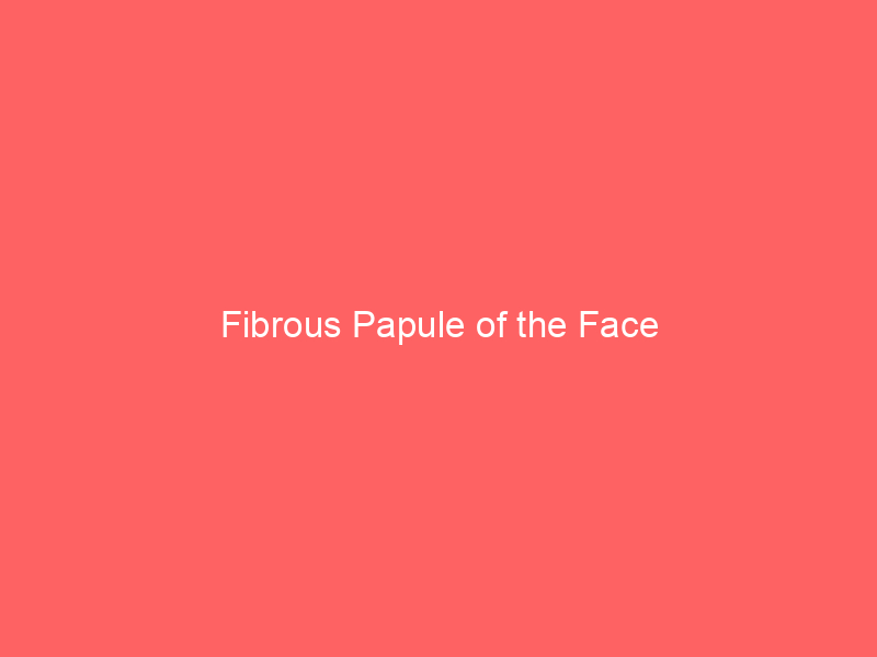Fibrous Papule of the Face