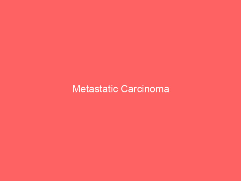 Metastatic Carcinoma
