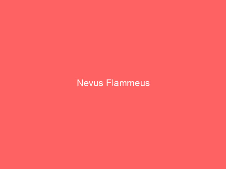 Nevus Flammeus