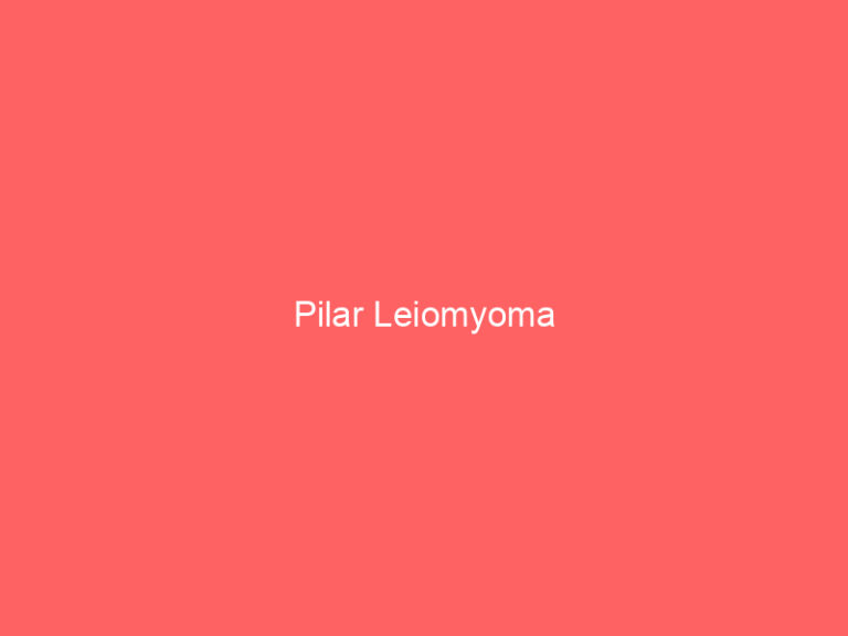 Pilar Leiomyoma
