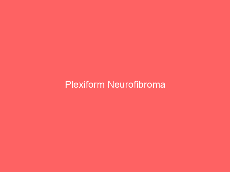 Plexiform Neurofibroma