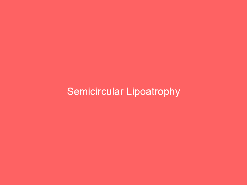 Semicircular Lipoatrophy