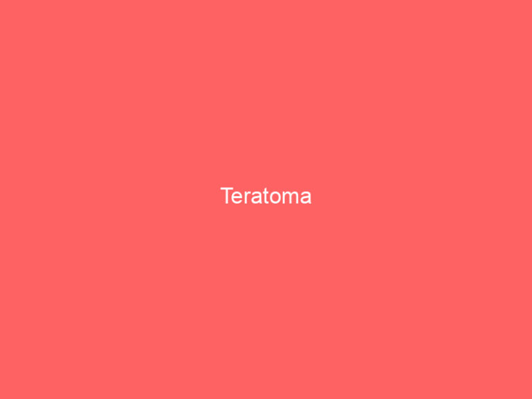 Teratoma
