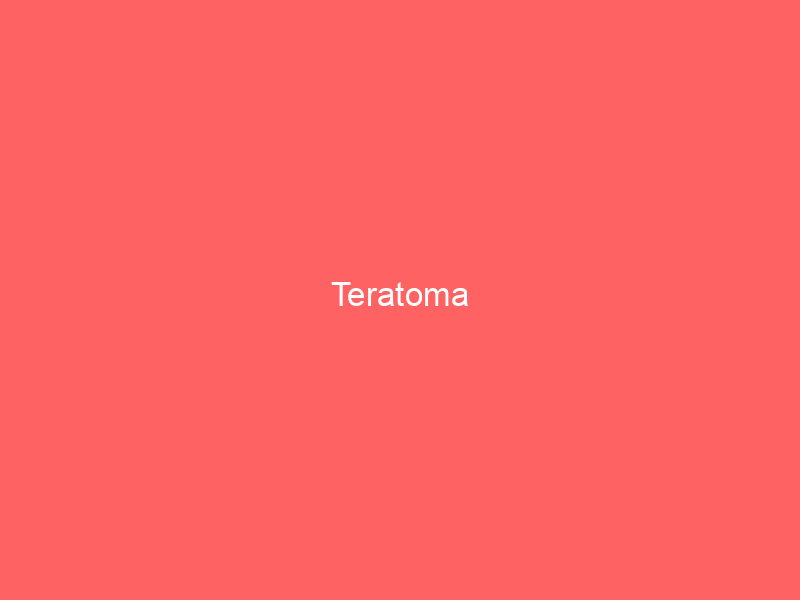 Teratoma
