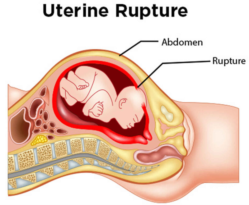 Ruptured Uterus - Causes, Symptoms, Diagnosis, Treatment Ruptured Uterus - Causes, Symptoms, Diagnosis, Treatment