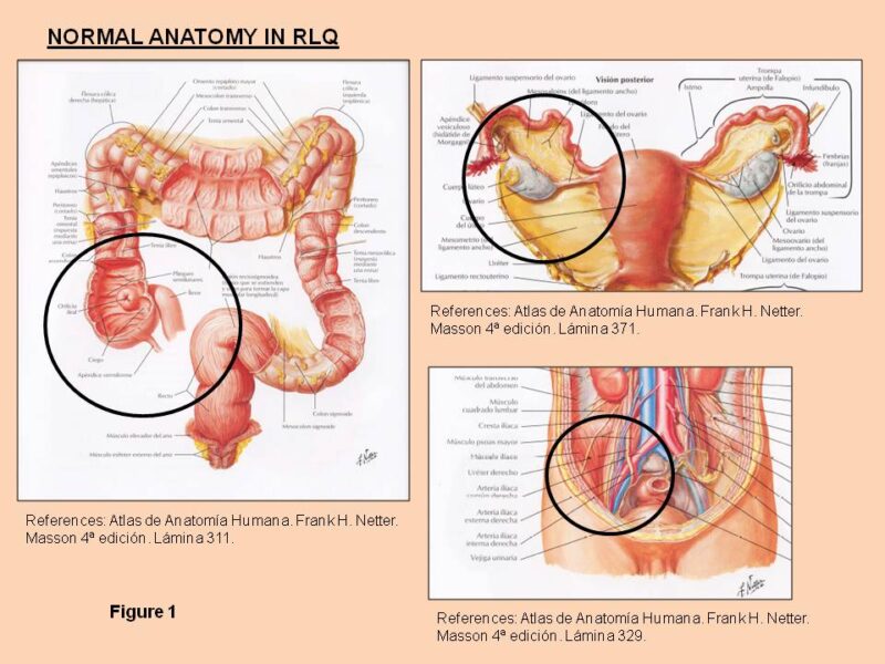 Post Ileal Appendix Dysfunction