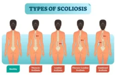 Scoliosis – Causes, Symptoms, Diagnosis, Treatment