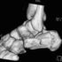 Calcaneus Fractures – Causes, Symptoms, Treatment