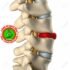 C5 and C6 Disc Herniation – Causes, Symptoms, Treatment