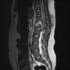 Slipped Disc – Causes, Symptoms, Diagnosis, Treatment