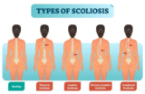 Scoliosis – Causes, Symptoms, Diagnosis, Treatment