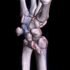 Fracture of Distal Radius – Causes, Symptoms, Treatment