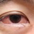 Retinal Detachment, Causes, Symptoms, Diagnosis, Treatment