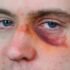 Black Eye Causes, Symptoms, Treatment