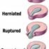 L2 and L3 Disc Herniation – Causes, Symptoms, Treatment