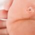 What Are The Main Types of Warts, Treatment