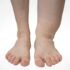 Filariasis Symptoms, Diagnosis, Treatment