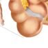 Appendicitis Causes, Symptoms, Treatment
