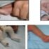 What Are Different Types of Skin Diseases?