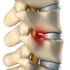 L1 and L2 Disc Herniation – Causes, Symptoms, Treatment