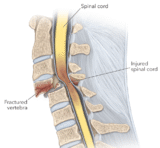 Spinal Cord Injury (SCI) – Causes, Symptoms, Diagnosis, Treatment
