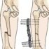 Femoral Shaft Spiral Fractures – Diagnosis, Treatment
