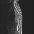 Test Diagnosis of Tuberculous Spondylitis – Treatment