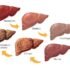 What are the first signs of liver damage from alcohol?