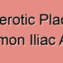 Atherosclerotic Stenosis of Common Iliac Artery