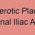 Internal Iliac Artery Coarctation