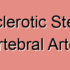 Atherosclerotic Fibrous Plaque of Vertebral Artery
