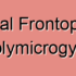Unilateral Frontoparietal Polymicrogyria
