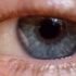 Blepharitis Diagnosis, Symptoms, , Treatment