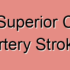Hemorrhagic Superior Cerebellar Artery Stroke