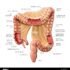 Transverse Colon Cancer